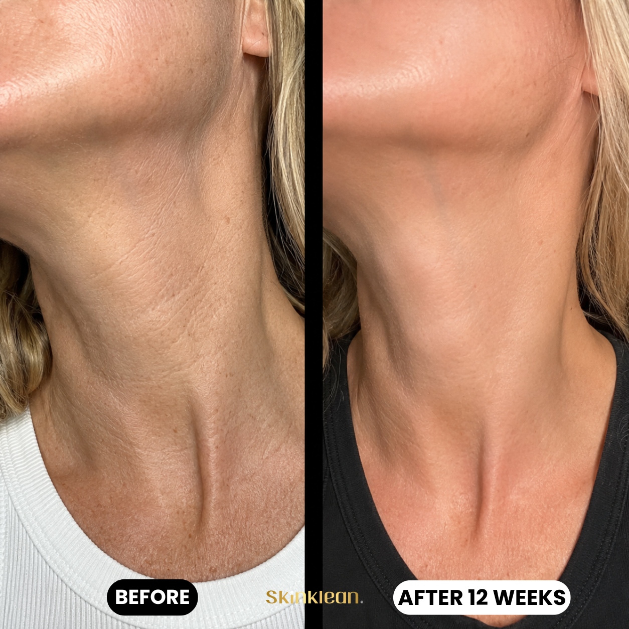 Baby Collagen NECK Mask