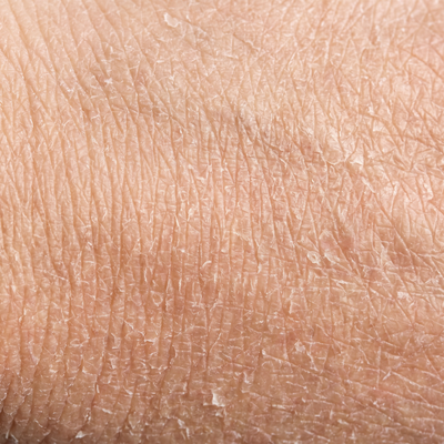 Dry and dehydrated skin