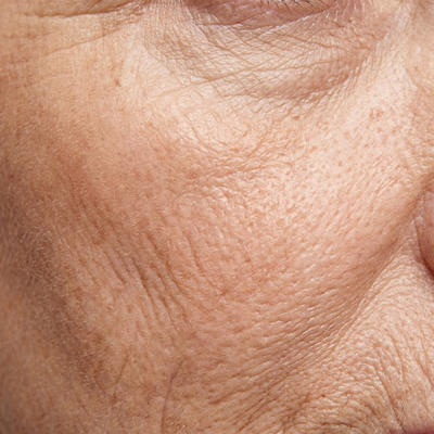 Fine lines and wrinkles